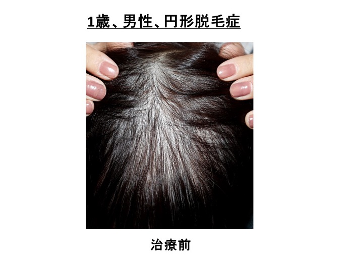 円形脱毛症　病院
